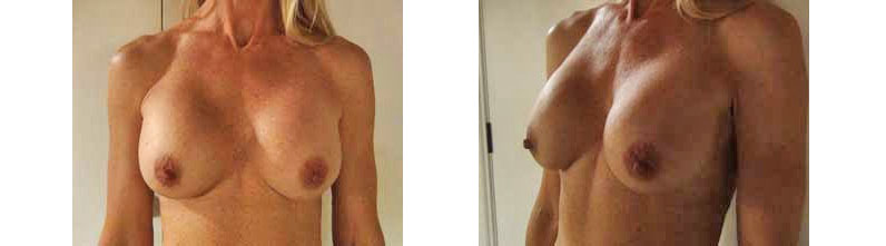 Uti's Breast Augmentation