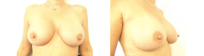 Yvette's Breast Augmentation