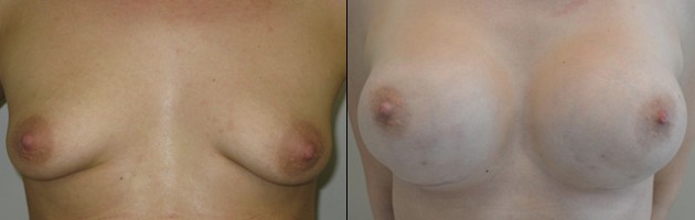 Renee's Story - Tuberous Breasts