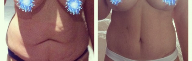 Jessicas Success Story - Jessie - My Body Lift and Breast Lift & Augmentation