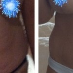 Jess' Patient Story - Body Lift & Breast Surgery after Massive Weight Loss