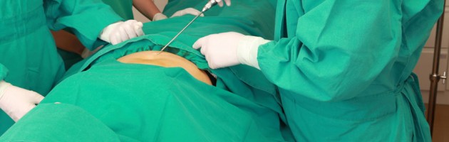 Having Liposuction - tips for a faster recovery