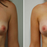 Belinda's Breast Augmentation