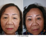 Asian Blepharoplasty- Before & After