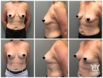 Breast Augmentation & Lift by Dr Ross Farhadieh