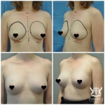Breast Augmentation by Dr Ross Farhadieh