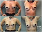 Breast Implant Revision by Dr Ross Farhadieh