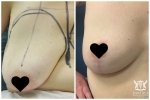 Breast Lift by Dr Ross Farhadieh