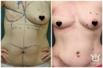 Breast Reconstruction by Dr Ross Farhadieh