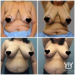 Breast Reduction by Dr Ross Farhadieh