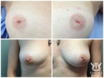 Inverted Nipple Correction by Dr Ross Farhadieh