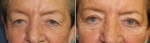 Blepharoplasty by Dr Damian Marucci
