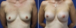 Breast Augmentation by Dr Damian Marucci