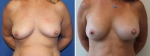 Breast Augmentation by Dr Damian Marucci