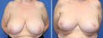 Breast Reduction by Dr Damian Marucci