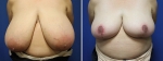 Breast Reduction by Dr Damian Marucci