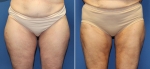 Liposuction by Dr Damian Marucci