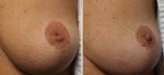 Inverted Nipple Correction by Dr Damian Marucci