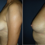 Breast Reduction Photo Gallery - BR Patient 1 - side on Plastic Surgery Hub