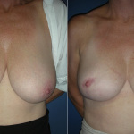 Breast Reduction Photo Gallery - BR Patient 2 - front on Plastic Surgery Hub