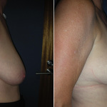 Breast Reduction Photo Gallery - BR Patient 2 - side on Plastic Surgery Hub