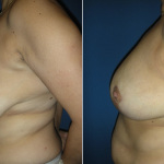 Breast Reduction Photo Gallery - BR Patient 4 - side on Plastic Surgery Hub
