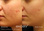Excel V - Acne treatment