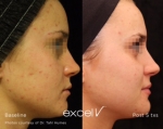 Excel V - Acne treatment
