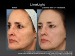 LimeLight Treatment