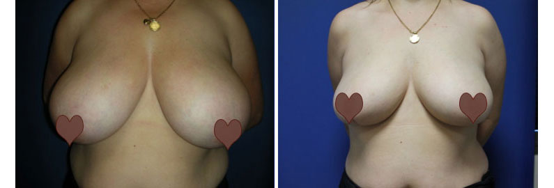 Jeanette's Breast Reduction