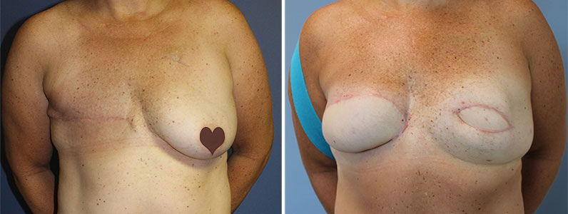 Tina's Bilateral Breast Reconstruction