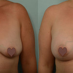 Julie's Breast Augmentation