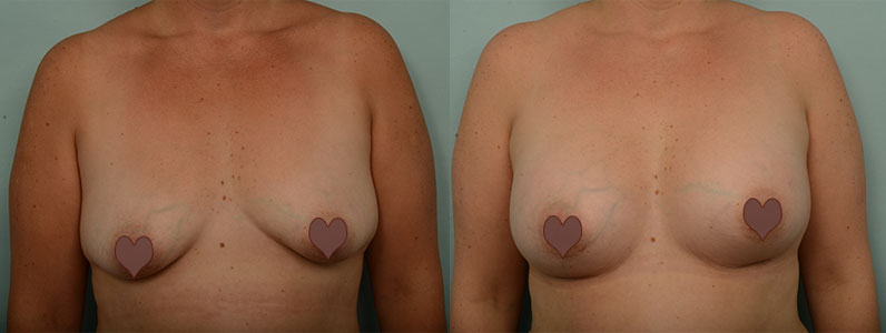 Julie's Breast Augmentation