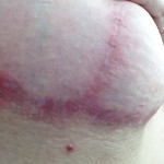 Scar infections after surgery in Thailand - overseas plastic surgery