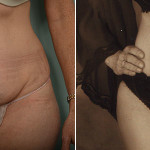 Charlie Before & After Her Tummy Tuck