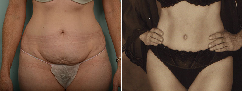 Charlie Before & After Her Tummy Tuck