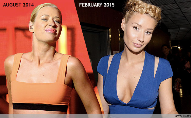 Iggy Azalea's Boob Job - Before & After