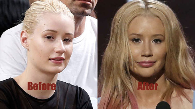 Iggy Azalea's Nose Job - Before & After