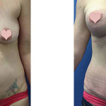 Stephanie's Tummy Tuck and Breast Lift with Implants