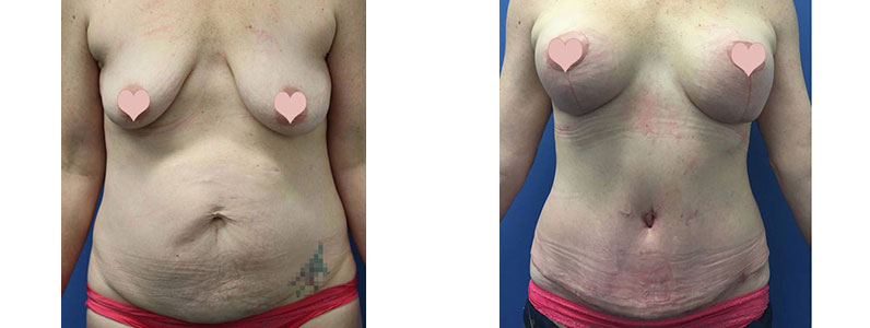 Stephanie's Tummy Tuck and Breast Lift with Implants