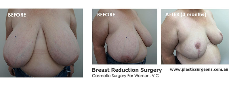 Karen's Breast Reduction - Karens breast burden