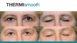 Thermi RF - Before & After