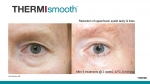 Thermi RF - Before & After