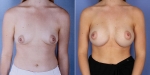 Dr Anh - Breast Augmentation - Before & After