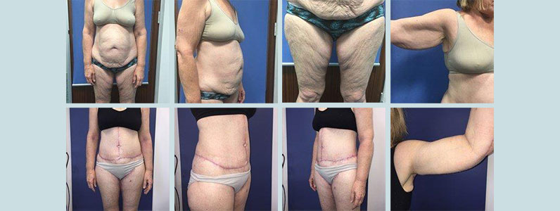 Adele truSculpt - Before & After