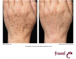 Fraxel before & after
