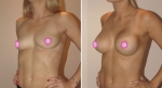 Chloe's Breast Augmentation - Before & After - new nose and breast