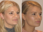 Chloe's Rhinoplasty - Before & After - new nose and breast