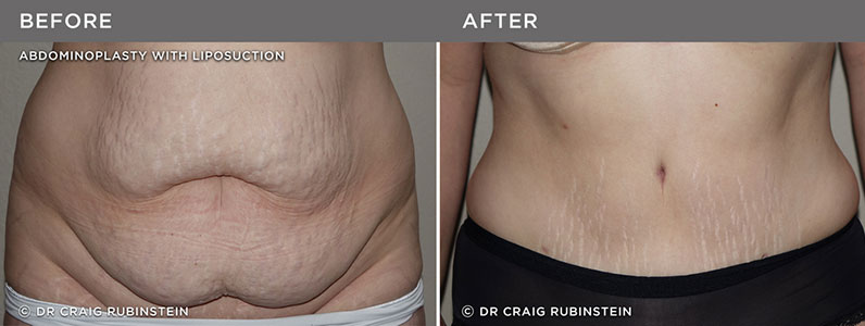 Shae's Tummy Tuck - Before & After