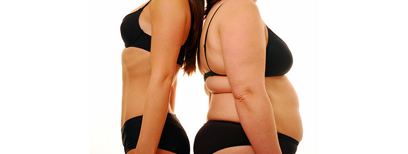 Body contouring after massive weight loss
